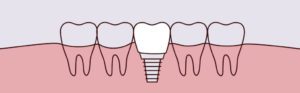 An illustration of a dental implant that would support dentures.