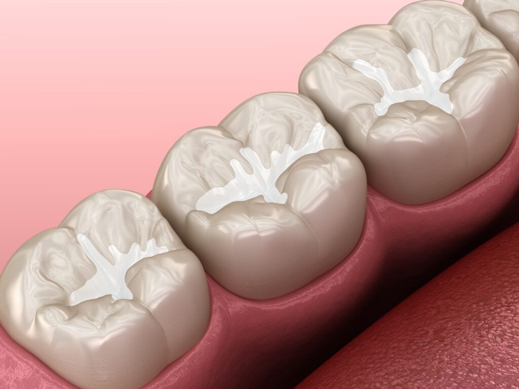 A graphic image of teeth with composite fillings.