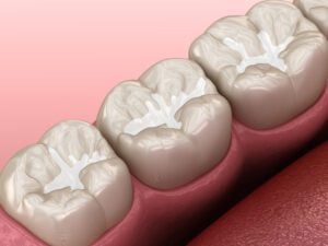 A graphic image of teeth with composite fillings.
