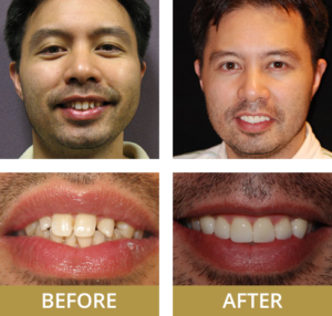 A before and after photo for the cosmetic dentistry treatments of a patient of The Plano Dentist.