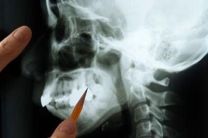 An image of a jawbone being examined by a dentist.