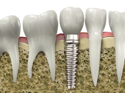 A dental impant embedded in the jawbone, a graphic image.